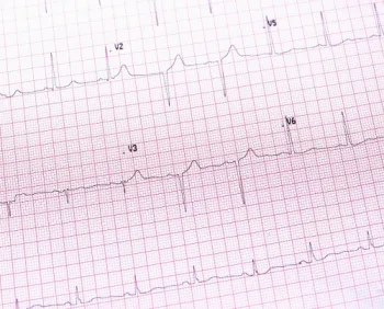 EKG/ECG lab testing Brooklyn 